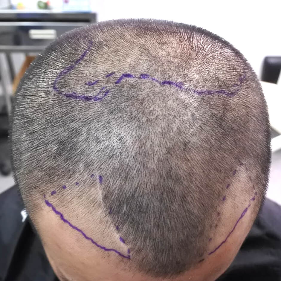 植髮 禿頭  掉髮 楊氏羅丹